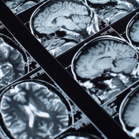mri-or-magnetic-resonance-imaging-of-the-head-and-2023-11-27-05-18-32-utc 2